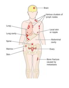 Breast cancer can spread to the bones, brain, liver and lungs